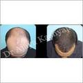 Manufacturers Exporters and Wholesale Suppliers of Hair Transplant Surgery New Delhi Delhi